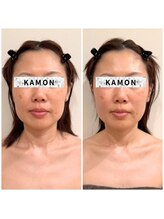 カモン(KAMON)/☆筋膜小顔矯正