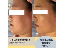 サロンド ララ(Salon de lala)の雰囲気（レモンボトルとリゼネレートでなりたい自分に♪脂肪分解×毛穴）