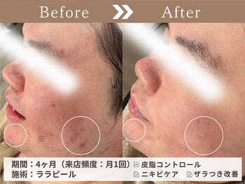 ファッショニスタ 恵比寿東口(Fashionista)/ララピール/ニキビ ざらつき改善