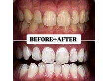 ホワイトニングサロン 豊中/Before&After美白ホワイトニング