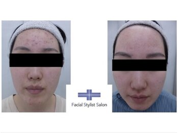 フェイシャルスタイリストサロン 四谷店/ケア例(24)