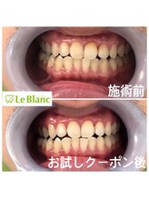 ルブラン 奈良店(Le Blanc)/お口元隠さずに