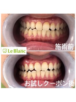 ルブラン 奈良店(Le Blanc)/お口元隠さずに