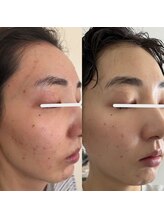 ウイユ(Oeil)/剥けるハーブピーリング 効果7回