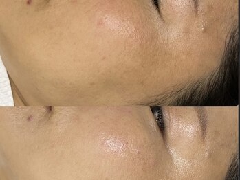 エース(ace)/艶肌爆誕セラピール