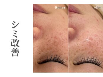 エトレ(etre)/シミ/シワ改善/たるみケア/毛穴