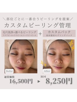HEYON【毛穴/肌質改善専門サロン】心斎橋の写真/AI肌解析付☆【人気No.1◇カスタム毛穴管理】毛穴洗浄+選べるピーリング&モデリングパック初回¥8250】