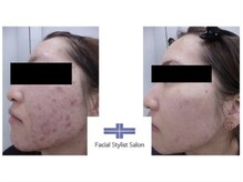 フェイシャルスタイリストサロン 四谷店/ケア例(25)