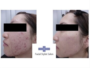 フェイシャルスタイリストサロン 四谷店/ケア例(25)