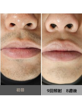 キムラケ 和光別邸(木村家 KIMURAKE)/メンズ脱毛ヒゲビフォーアフター