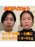【キャンペーン】小顔鍼＋ダイエットカウンセリング ¥7980