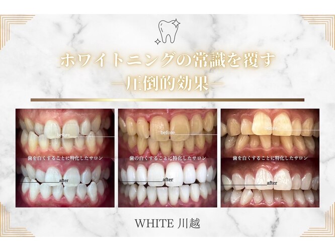 歯のホワイトニング専門店WHITE 川越店