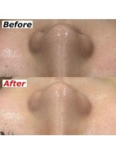 ビーブルーセブン(B.BLUE7)/【ハイドロフェイシャル】