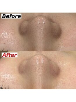 ビーブルーセブン(B.BLUE7)/【ハイドロフェイシャル】