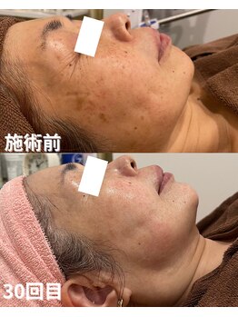 ブレス 天童店(BLESS)/シミケアコース