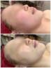 【美白/むくみ/毛穴】話題の還元水素フェイシャル