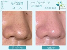 ボディコンディション/ハーブピーリング/毛穴洗浄/小顔