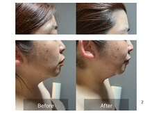 ラシェリー(La Cherie)/ビフォーアフター