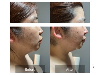 ラシェリー(La Cherie)/ビフォーアフター