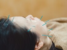 ファミリア鍼灸院 高田馬場(Familia鍼灸院)/美容鍼で肌の巡りを整えます