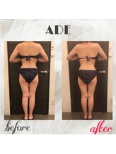 プライマルビューティ 艶 本店(Primal Beauty)/ハイパーナイフ施術後がすごい！