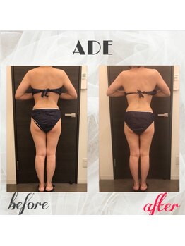 プライマルビューティ 艶 本店(Primal Beauty)/ハイパーナイフ施術後がすごい！