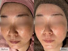 ティアラッシュ(TiaLash)/光フェイシャル