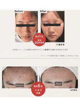 賢者のボディケア/繰り返すニキビに幹細胞導入