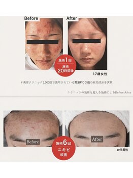 賢者のボディケア/繰り返すニキビに幹細胞導入