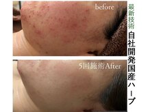 フロージア 新宿南口店(FLOGIEIA)の雰囲気（これまでの肌質改善をもとに2年かけて作られたこだわりのハーブ）