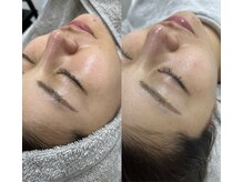 アイアール(ir)/施術前←　→ララピール2回目