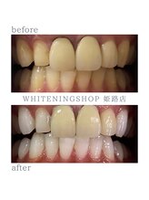 ホワイトニングショップ 姫路店/差し歯ありホワイトニング