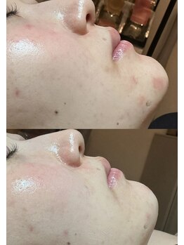 フィール(feel)/ビフォー アフター 3回施術