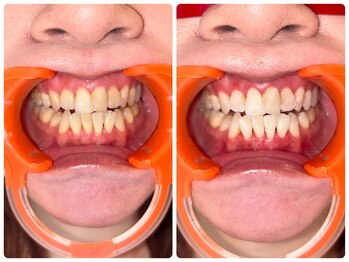 コナホワイトニング 神保町/初回ビフォア