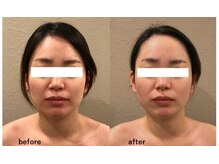 リュストゥール アンド フォンス(Lustr'e&fons)/フェイシャルハイパーナイフ