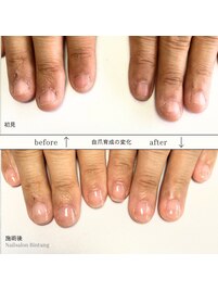 自爪育成/深爪矯正/長さ出し