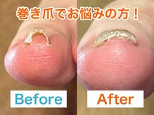 ぱんだ鍼灸接骨院 福井市巻き爪センター