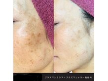 ラヴュークリスタルの雰囲気（トーンUPで美肌美人へ♪プラズマエステ〈フェイシャル〉陶器肌）