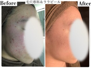 フレイヤ(FREYA)/毛穴＆ララピールBefore→After