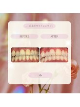 プラスビー 2号店(+b)/ホワイトニングビフォーアフター