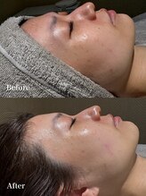 ウルソワン 都島店(/ulu soin)/くすみの改善　１回