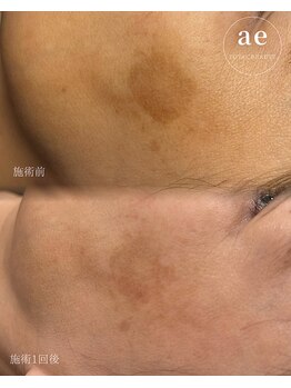 アエ(ae)/スポットクリア