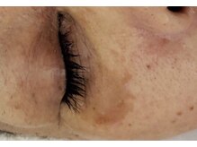 ピアーノ(PIANO)/エルモサハーブピーリング