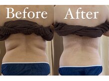 サロン ヌーク(salon Nook)/ボディケア/ハイパーナイフ