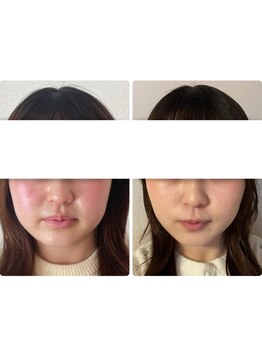 ミモザ 佐野(mimosa)/20代とにかく小顔に