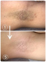 アンドユクス 表参道(and uks)/【症例】レディース/わき脱毛