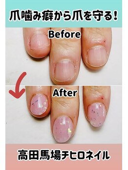 チヒロネイル/深爪・爪噛み保護用スカルプ