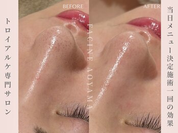 ファシネアオヤマ(FACINE AOYAMA)/毛穴洗浄1回での効果♪