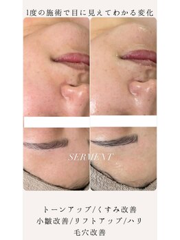 ヒュウ(hue.)/最速最短肌改善【セルマン】