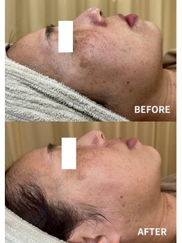 エヴェリーナ(Eveliiina)/極上シミケア40分 12回目